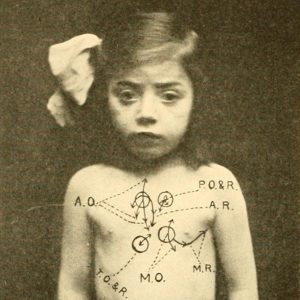 An amazing murmur