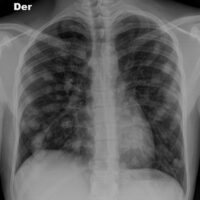 Chest X-ray showing multiple lung lumps
