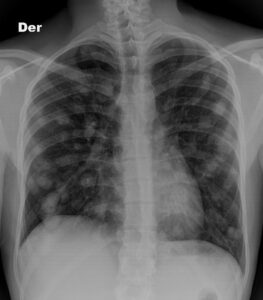 Chest X-ray showing multiple lung lumps