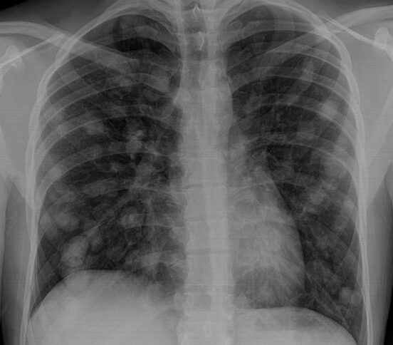 Chest X-ray showing multiple lung lumps